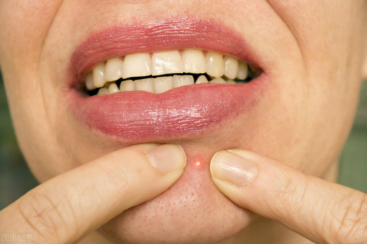 痘痘如何治疗4个皮肤科常见病例,痘痘也属于皮疹吗