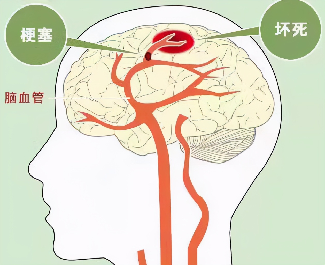 中风脑梗半边瘫痪怎么治疗,缺血性脑中风就是脑梗怎么治疗