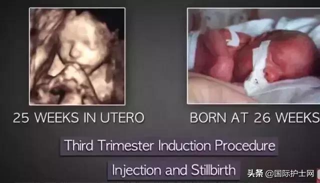 打胎有多可怕案例,20岁女生堕胎7次