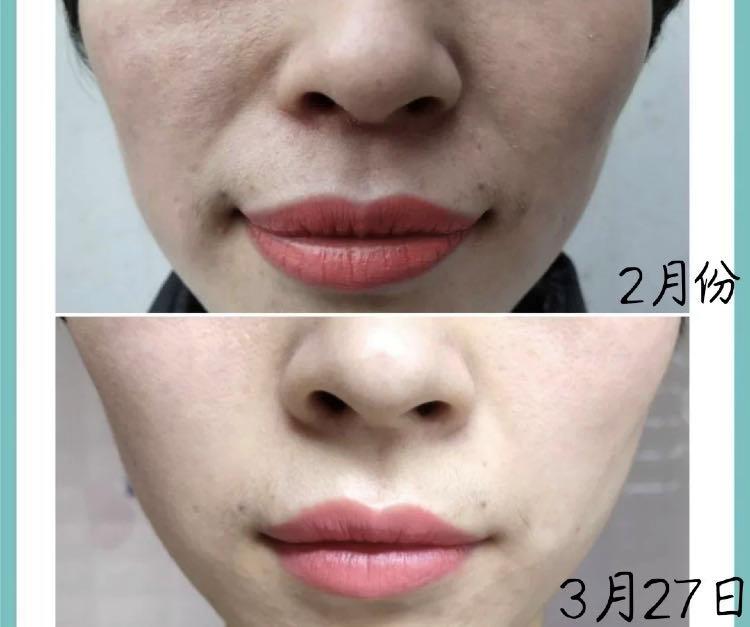 日本49岁贵妇为去皱，坚持用“开塞露”抗老长达20年，现今啥样？