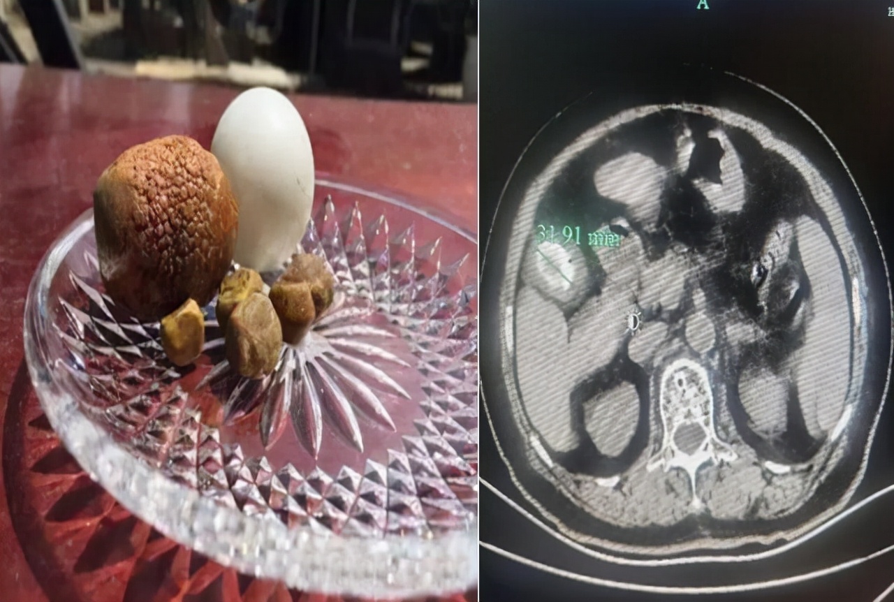 胆结石有乒乓球大小了,90多岁老太胆结石