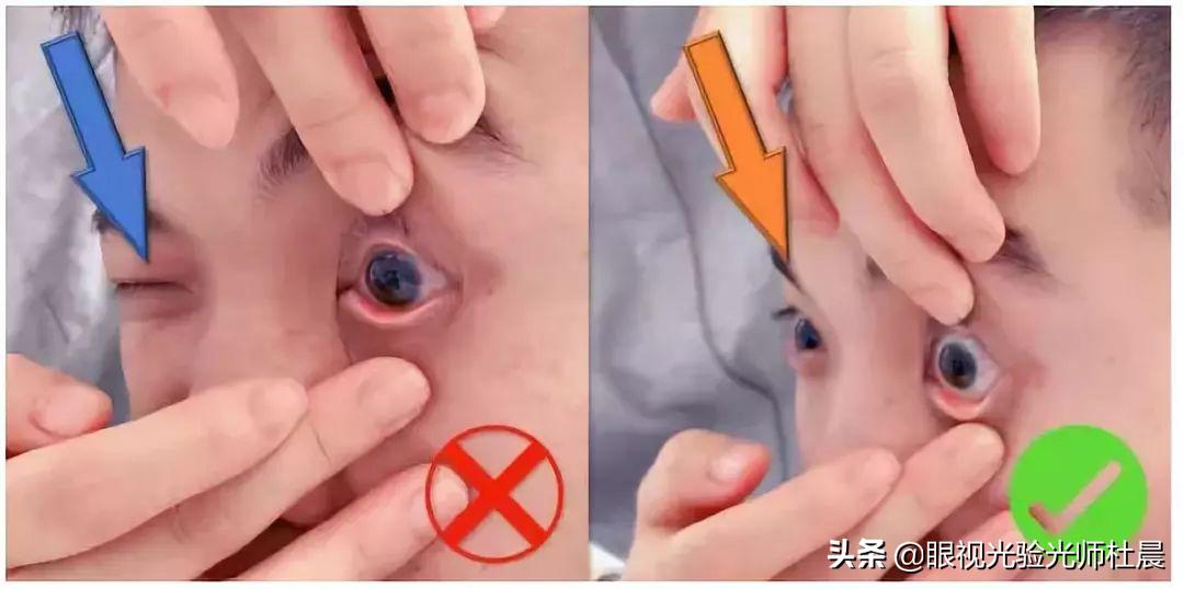 初次戴隐形眼镜感觉有点眩晕,初次戴隐形眼镜怎么取下来