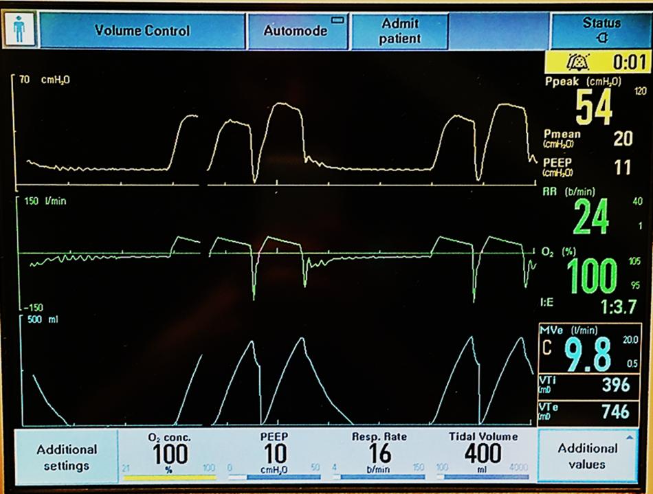 新冠肺炎机械通气系列课程(讲义)-阻塞性肺病的机械通气
