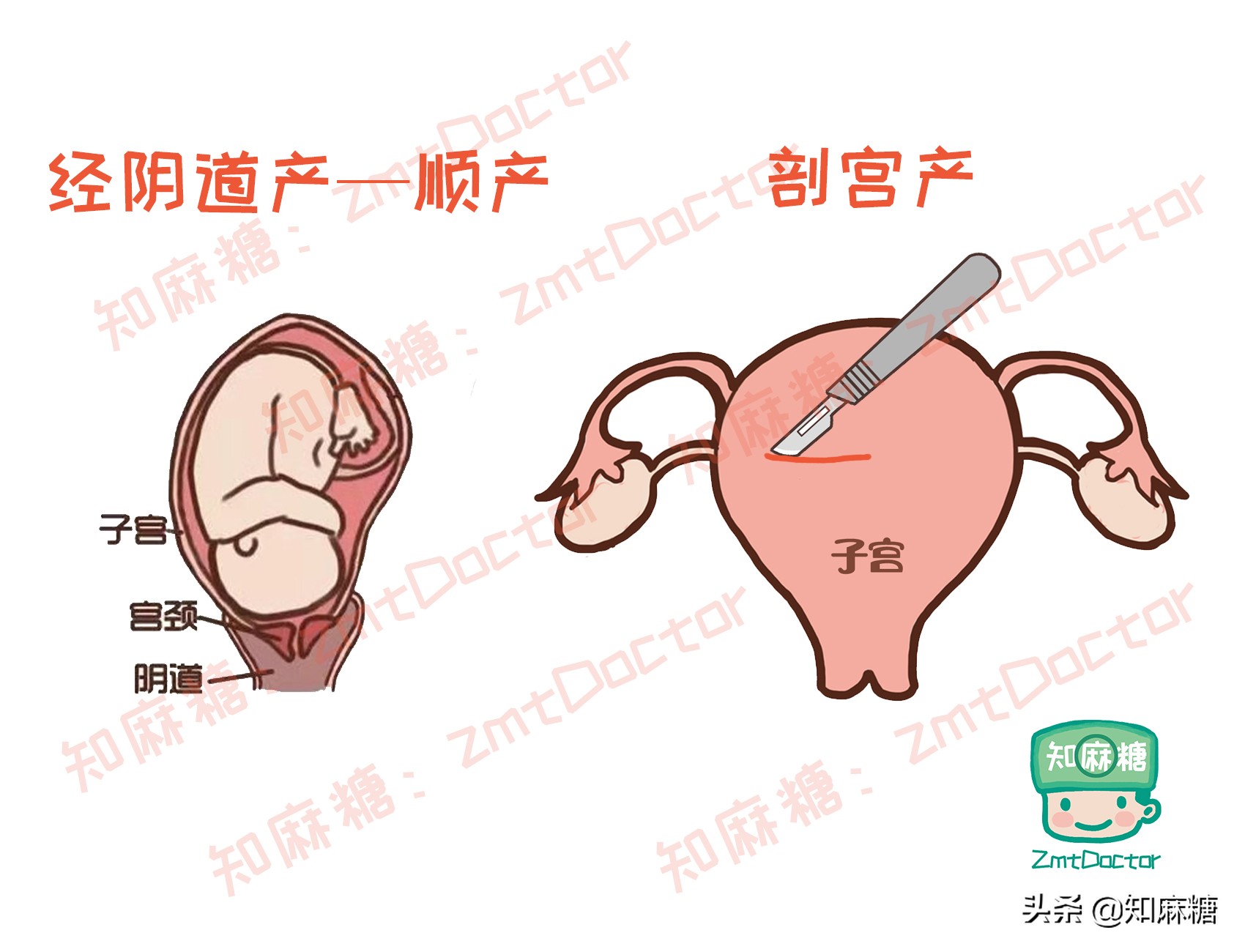 来自新生儿的控诉：剖宫产又多了一宗罪