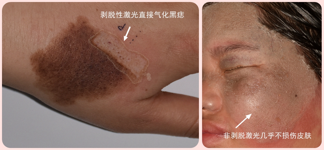 激光快速入门,激光美容专业科普小知识