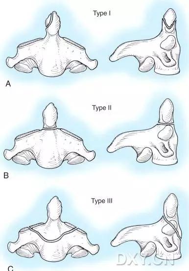 特殊骨折类型,特殊骨折体征