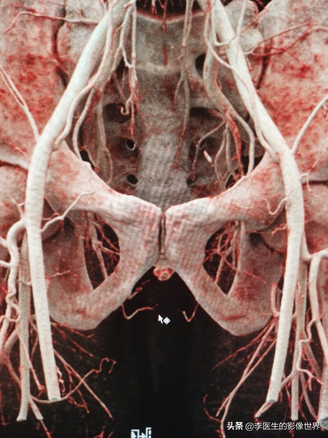 勃起功能障碍,ED之阴部内动脉CT血管成像