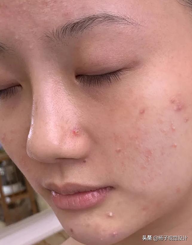 脸上长痘痘用什么洗脸皂,洗脸皂会使痘痘增多吗