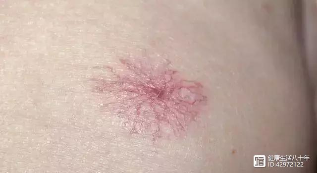 肝脏开始病变会有哪些症状,肝脏病变会有什么症状