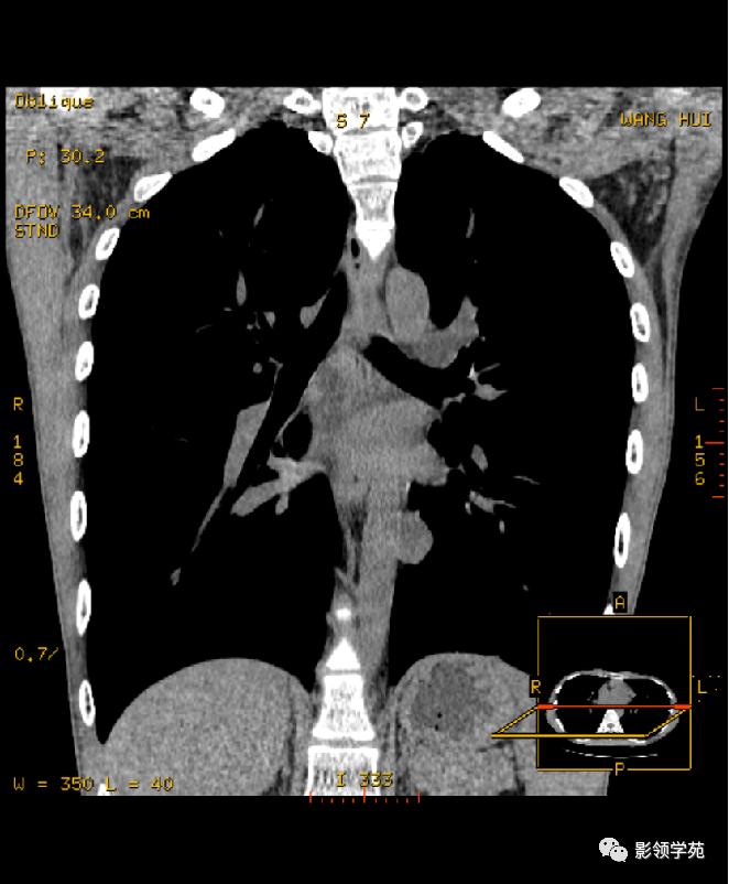 纵隔和肾上腺恶性肿瘤,纵隔性肿瘤位置图