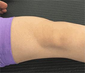 磁共振怎么看半月板损伤程度,磁共振半月板损伤1级是什么