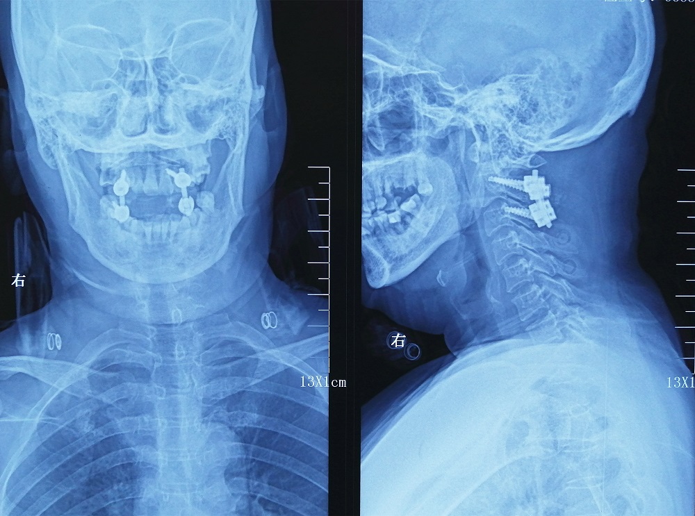 间歇性双手麻木是什么原因和征兆,双手指持续性发麻是什么原因