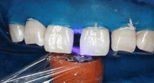 门牙裂了一条缝,门牙有缝的女人