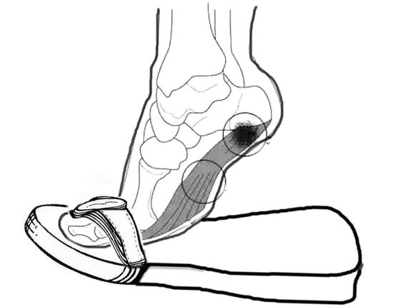 穿人字拖会影响脊椎吗,穿人字拖会导致畸形脚吗