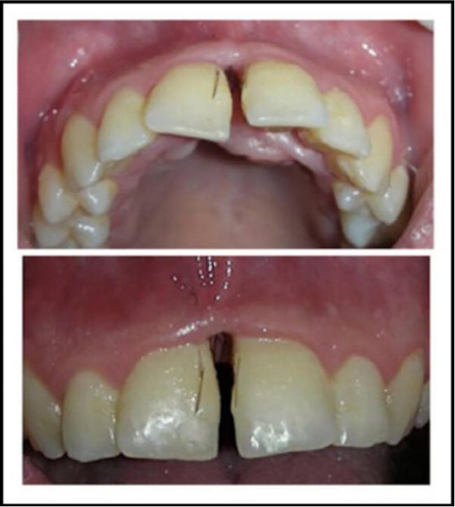 女性患多毛症,女孩患罕见疾病满脸长毛
