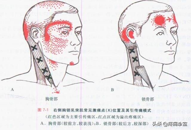 我的偏头痛怎么治好的,我的偏头痛一年多了反复发作