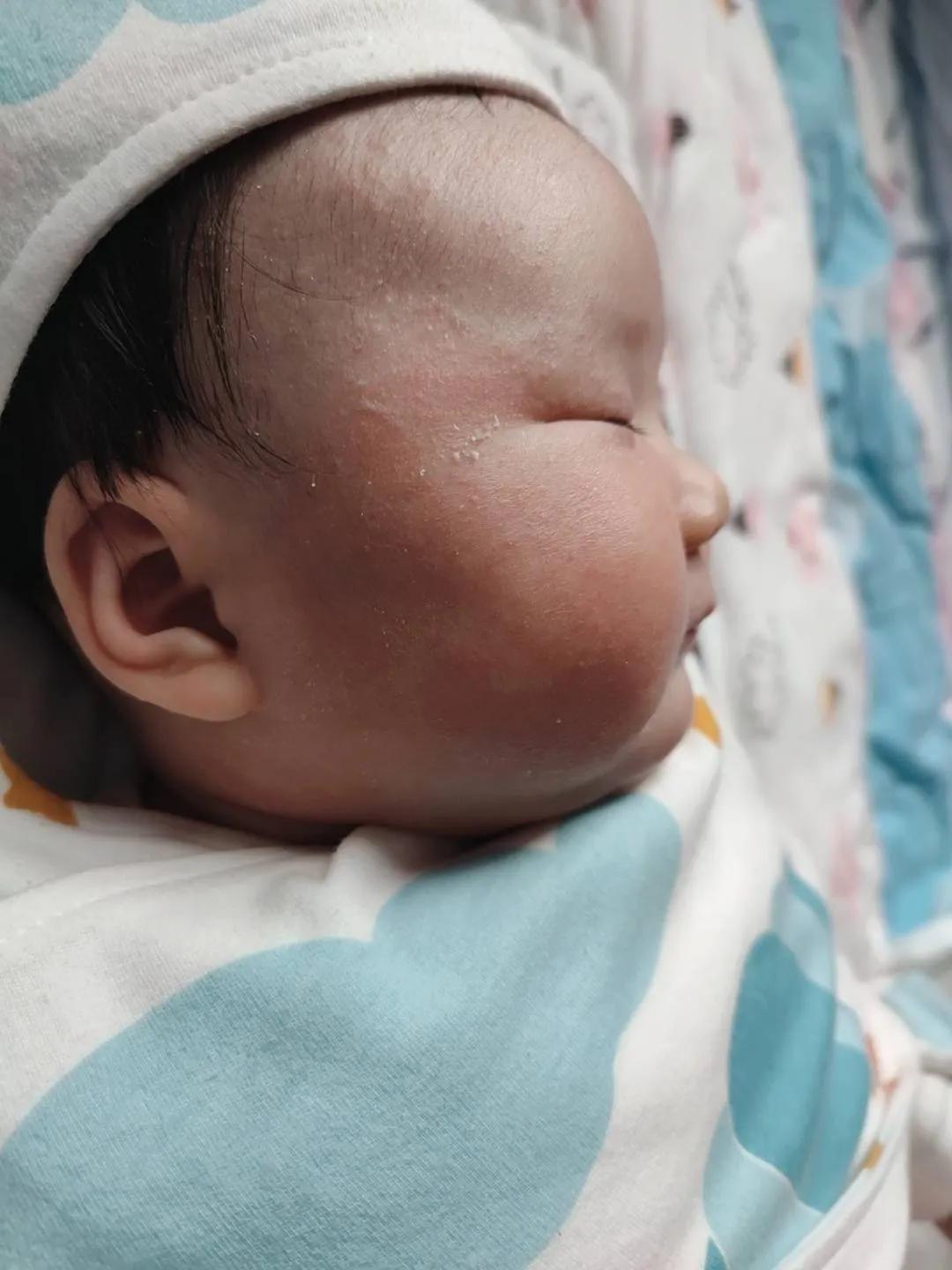 根治湿疹特效药,宝宝湿疹大作战图文