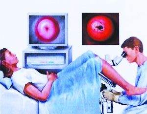 看了体检报告我懵了，这是不是宫颈癌？