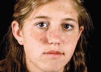 氨甲环酸美白精华,氨甲环酸日本