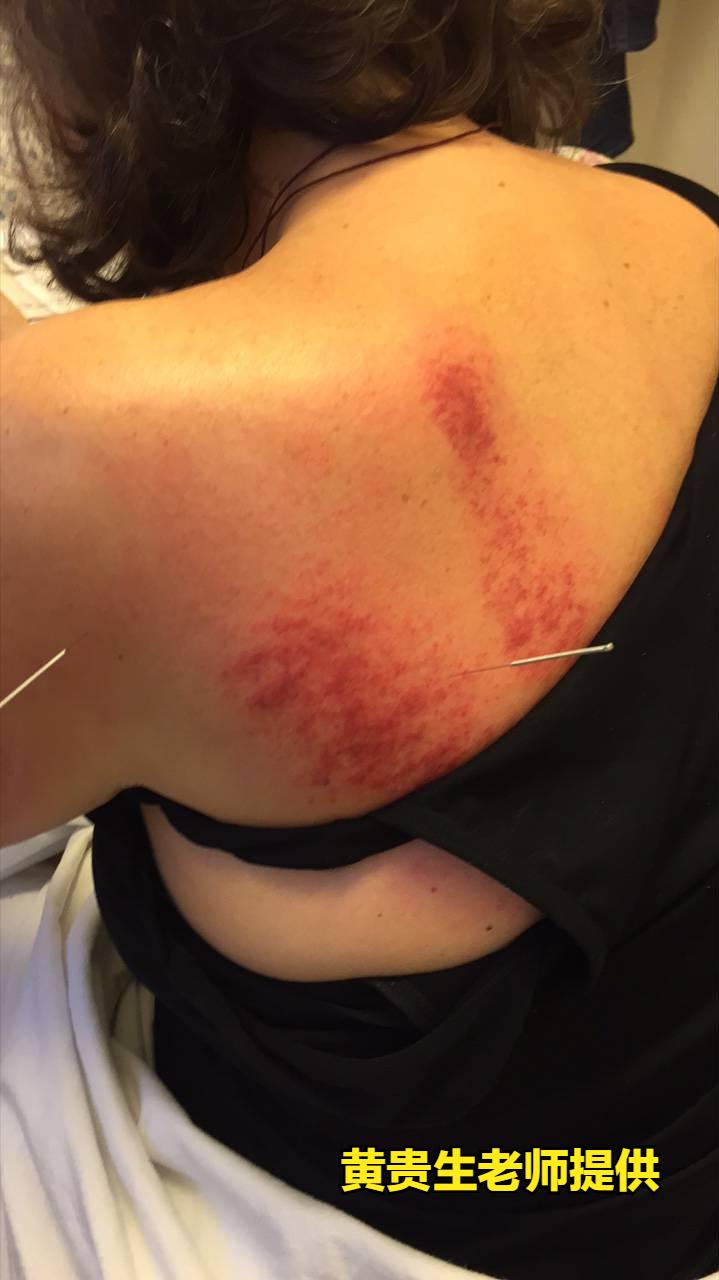 和癌症一起做斗争,癌症防治大赛