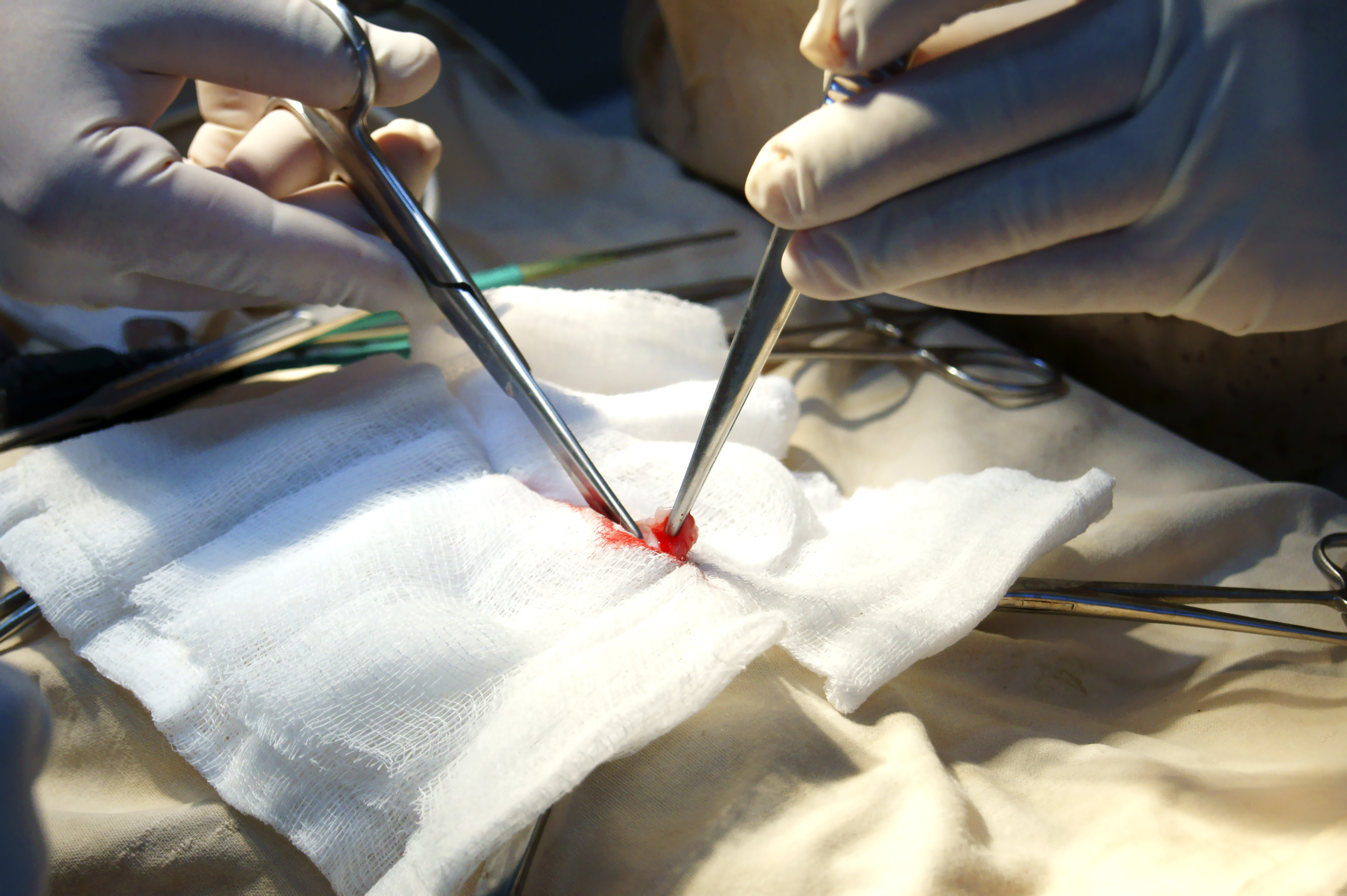 胃癌最有效的偏方,胃癌内镜下切除的优缺点