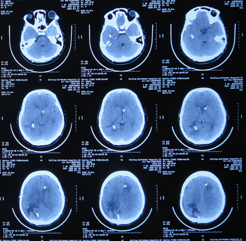 脑室有粘连脑积水有什么办法,脑动脉畸形手术后出现急性脑积水