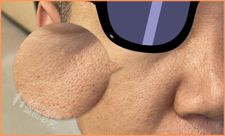 毛孔粗大问题应该如何正确解决,毛孔粗大怎么办教你一招根除