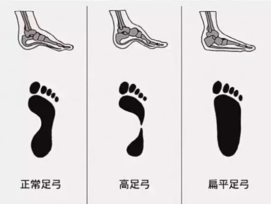 不同脚型选鞋注意事项,鞋不合脚就是我的问题
