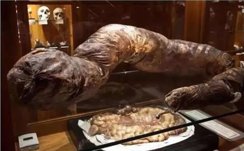 宫颈癌晚期不拉屎多久会死,如果孩子30天不拉屎会死吗