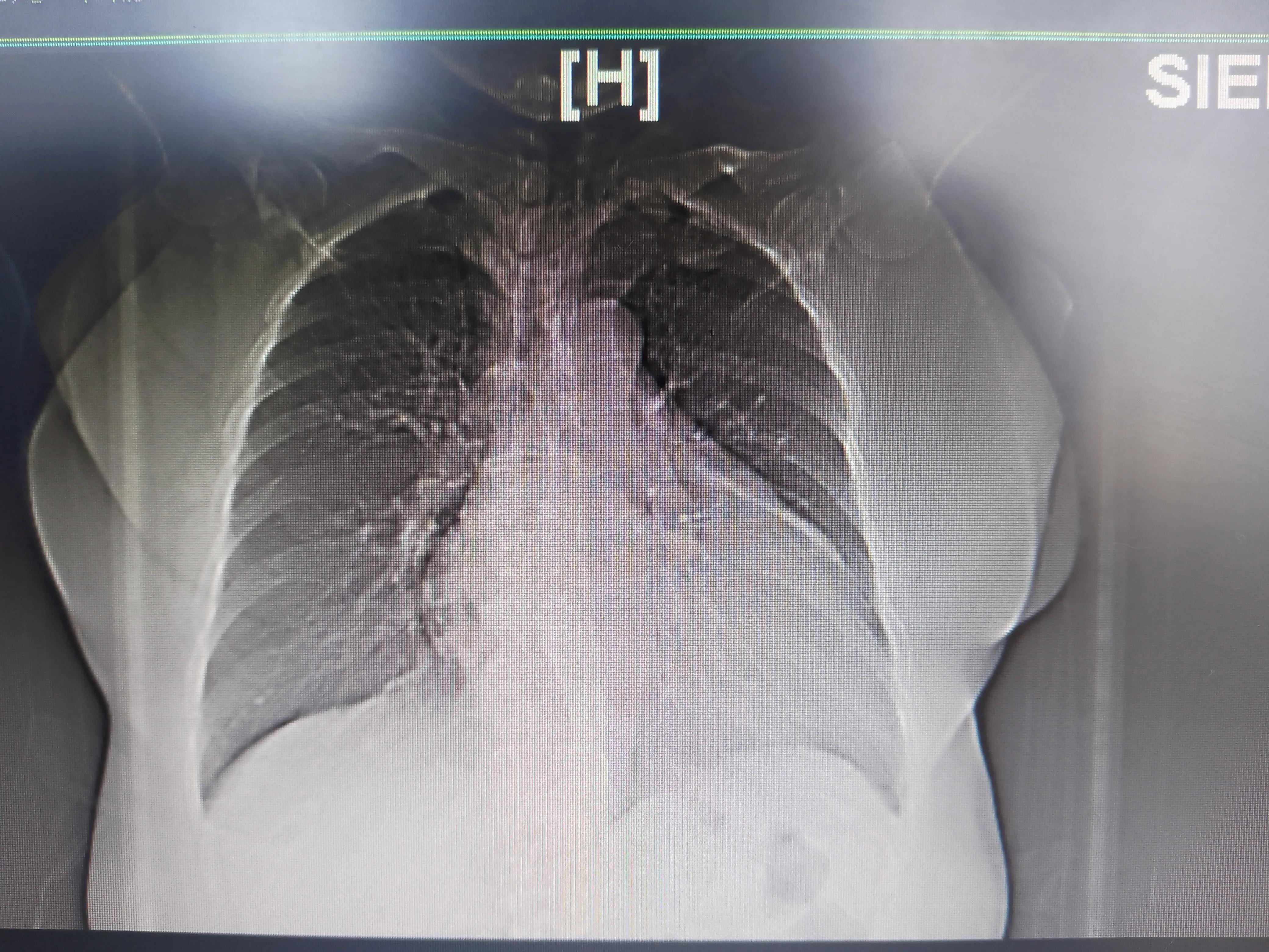 心血管病人吃伟哥,心血管病人可以用伟哥吗