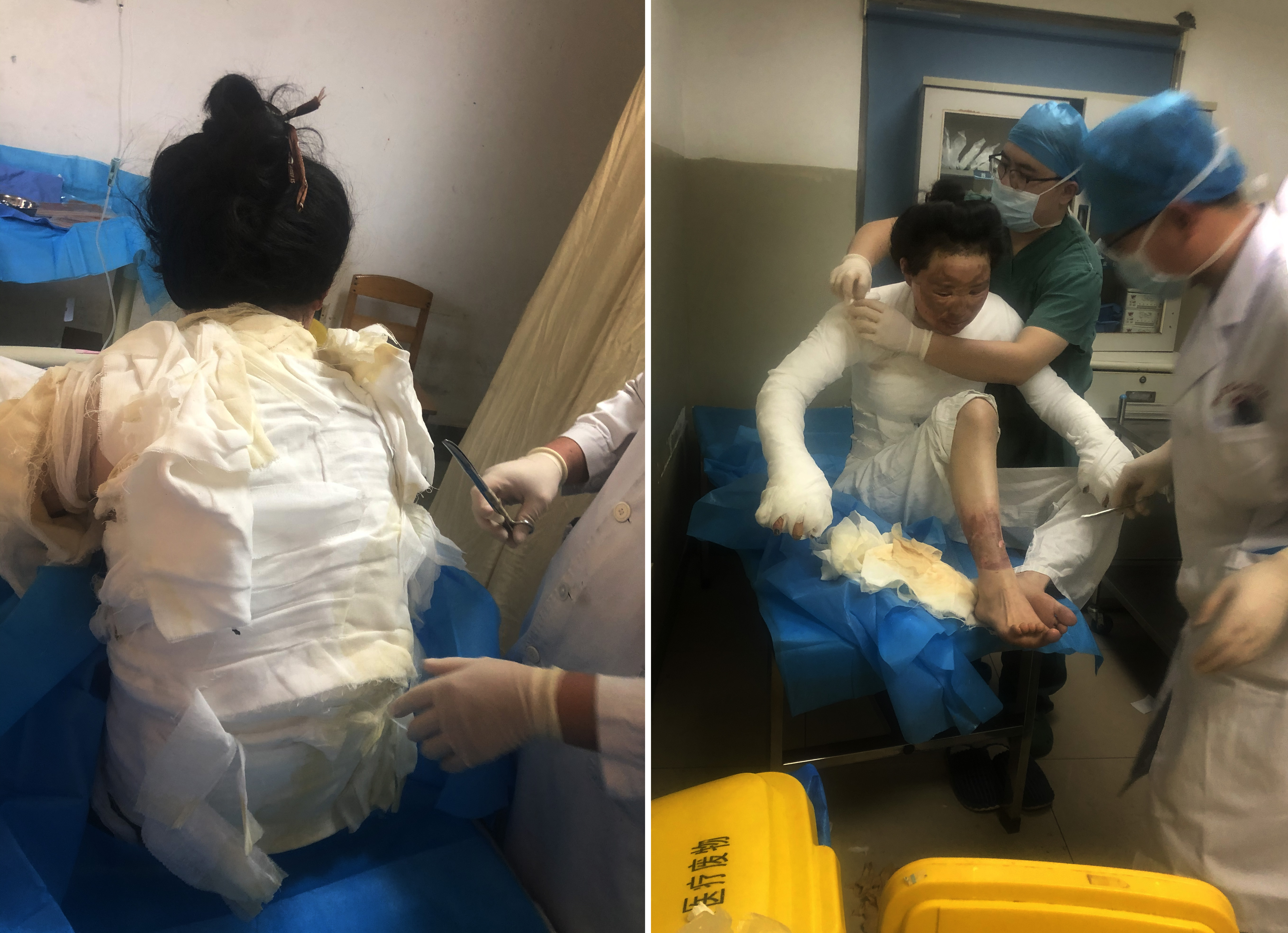 美女辣妈拔火罐烧伤如戴紧箍咒,美妈凌晨拔火罐烧伤