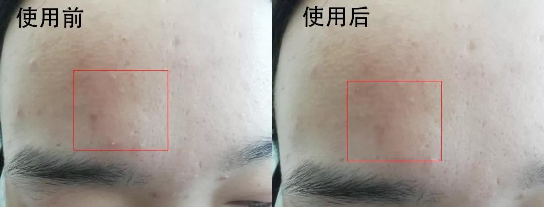 日本抗痘护肤品牌,日本护肤品淡斑美白排行榜