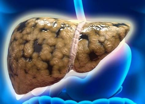 胆囊炎的危害及会引发什么并发症,胆囊炎不治会要命吗