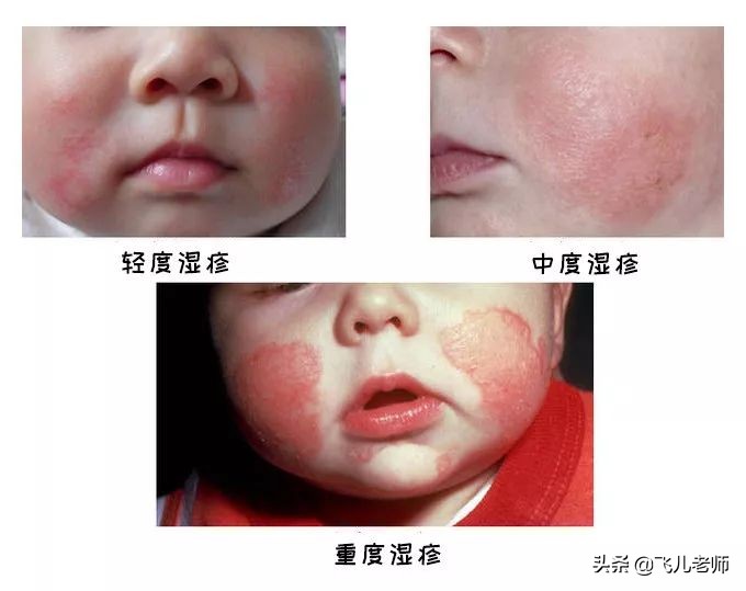 孩子湿疹的原因及处理方法,孩子湿疹老不好是怎么回事