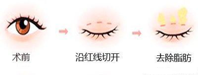 双眼皮、眼整形的误区，眼睛手术的坑，不要往里面跳了