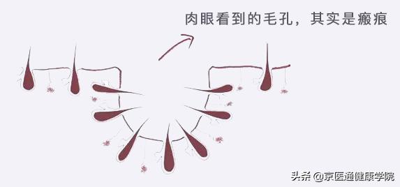 毛孔粗大的原因及改善方法,毛孔粗大的原因和治疗方法