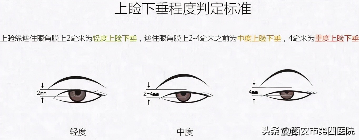 安心变美下巴整形,安心变美