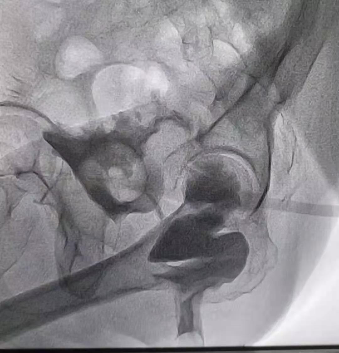 克罗恩病能否控制住不复发,克罗恩病中西医治疗好不