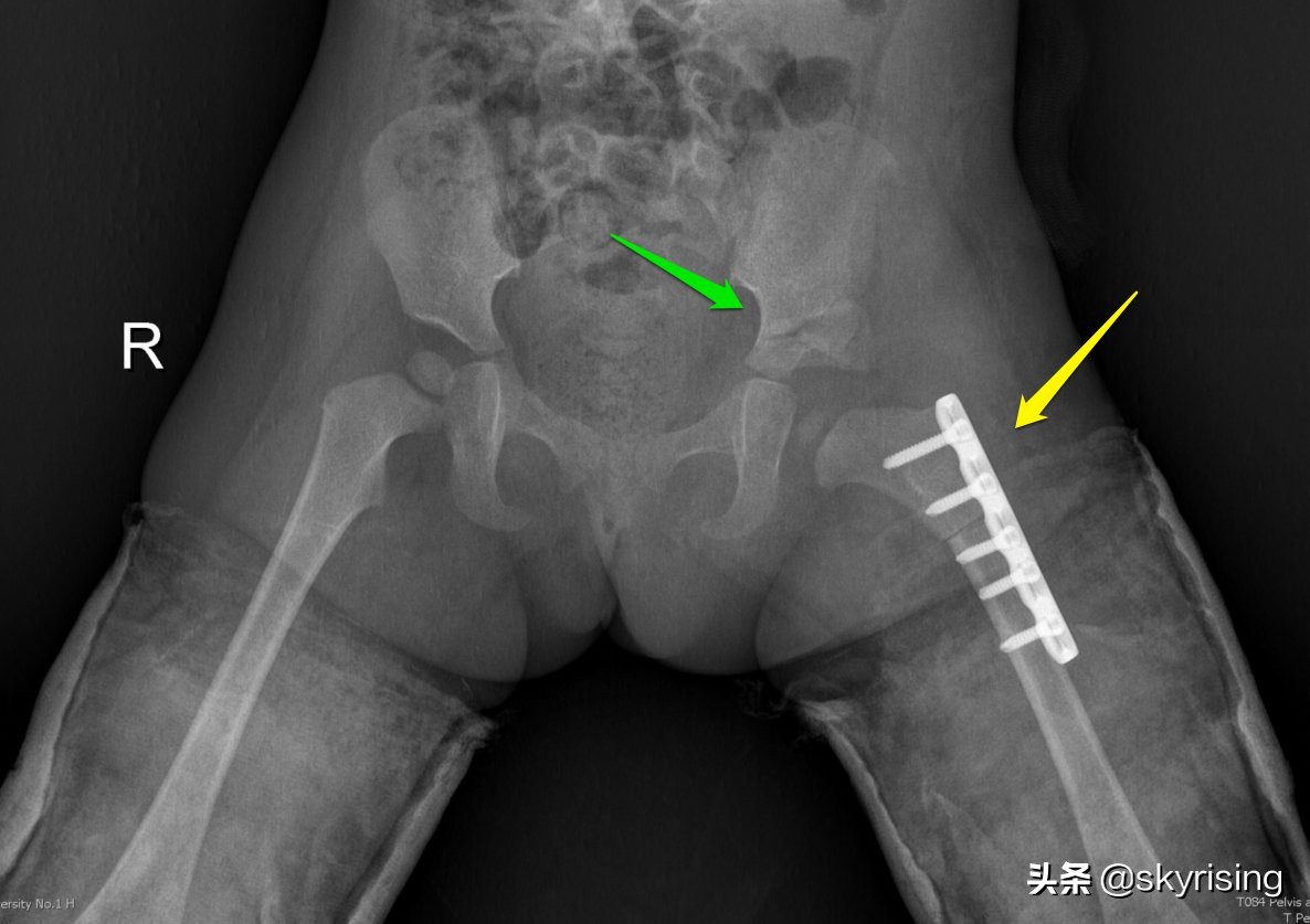 先天性髋关节发育不良婴儿期症状,婴儿先天髋关节脱位图片