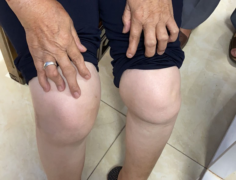 手指滑膜炎和类风湿滑膜炎,类风湿性关节炎与滑膜炎的区别