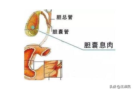 胆囊有息肉结肠有息肉怎么回事,胆囊息肉和结肠息肉哪个严重