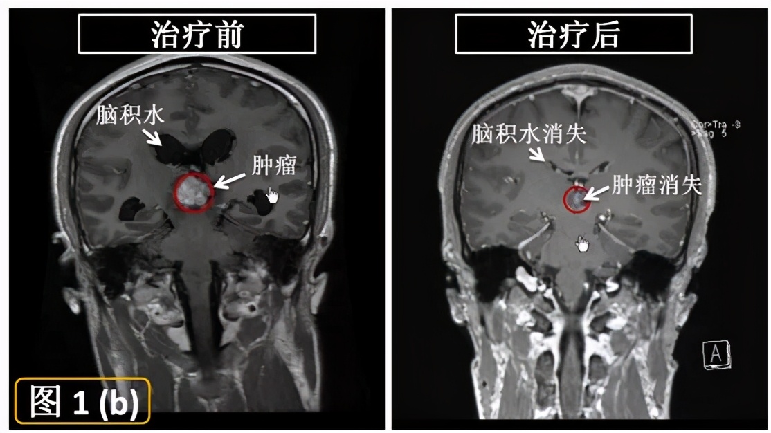伽玛刀治疗能治愈哪些疾病,无形胜有形完整版