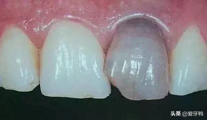 小孩把牙磕进去了怎么办,孩子磕到牙齿正确的处理方法