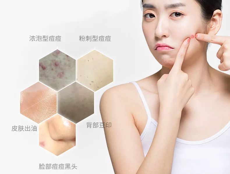 用这款植物香皂洗脸，3周除螨93.77%，痘痘明显改善，湿润不紧绷