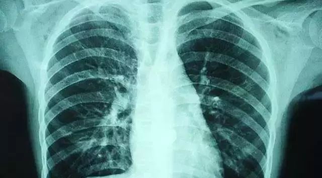 咽炎、干咳救命药！澳洲人的“肺部清道夫”！每天1片，堪比万元洗肺！再也不怕雾霾二手烟了