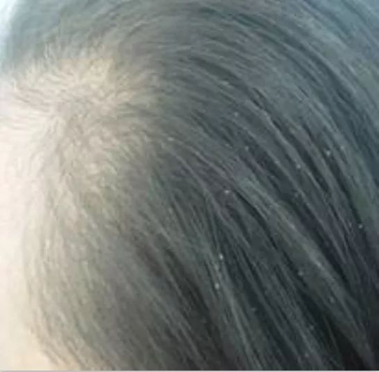 13岁女孩头皮屑多是什么原因,12岁的孩子女孩头皮屑非常多