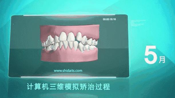 武汉种植牙齿多少钱一个,湖北种植牙补贴政策是真的吗