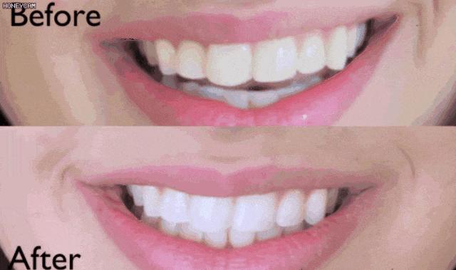 最好的口腔神器,好的去牙黄神器推荐