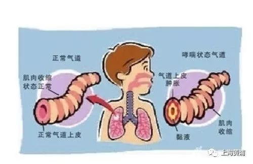 针灸治疗哮喘有效吗,针灸可以治哮喘吗