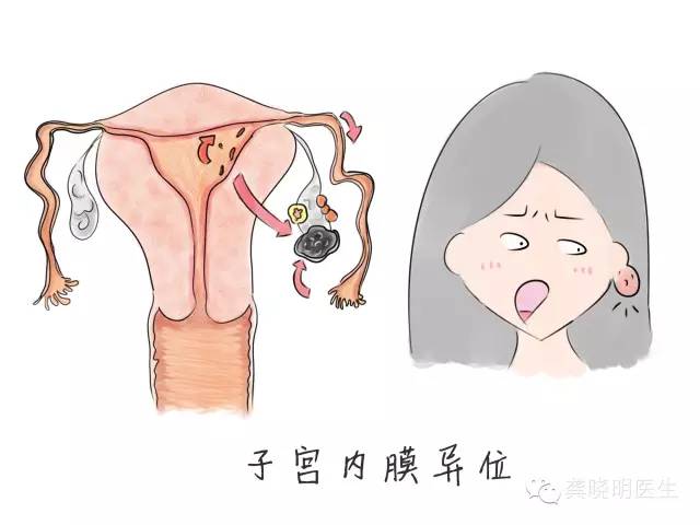 子宫内膜异位症——痛经的一种常见病因